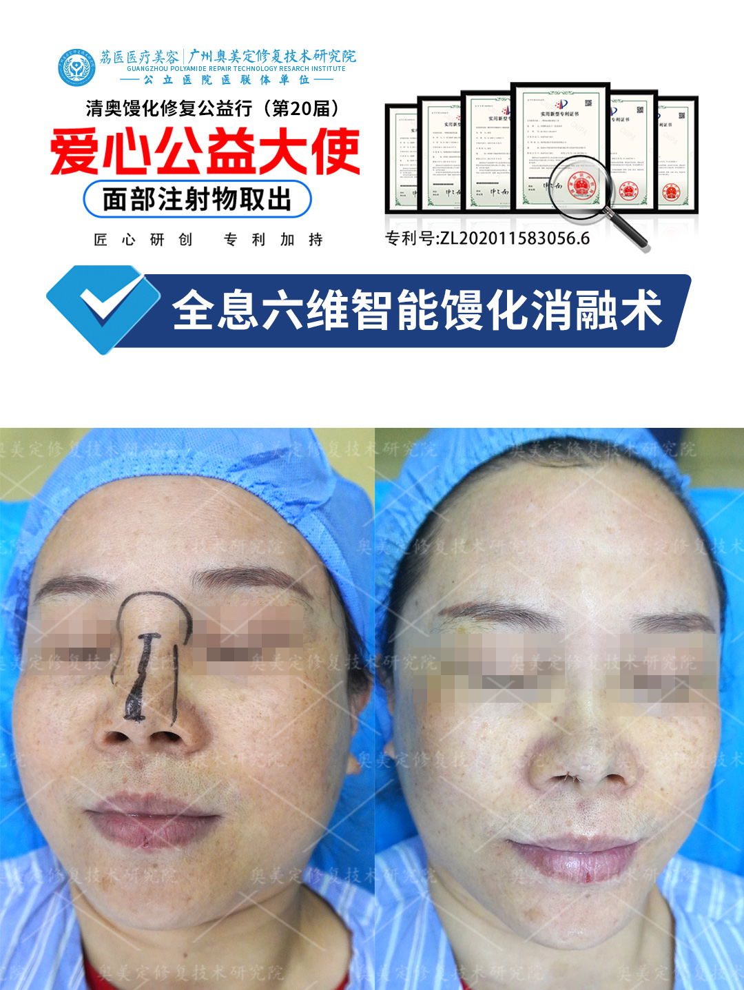 鼻部打了奥美定如何取出修复