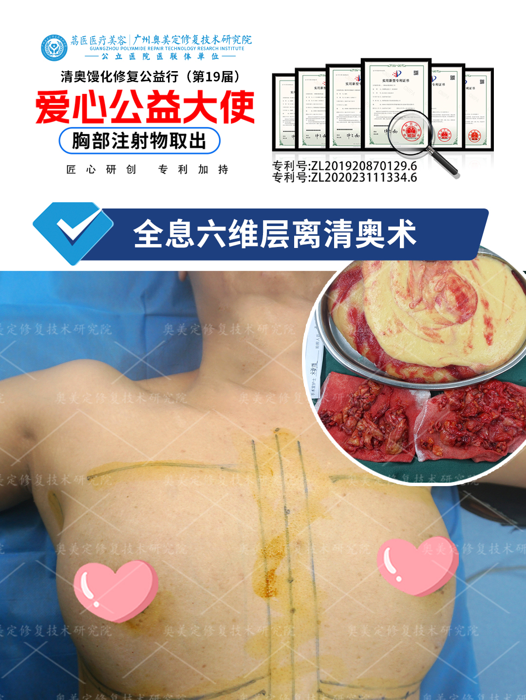 胸部注射非法材料后如何取干净呢？