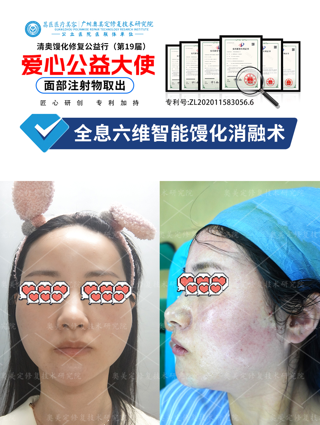 苹果肌注射不明材料后如何取出