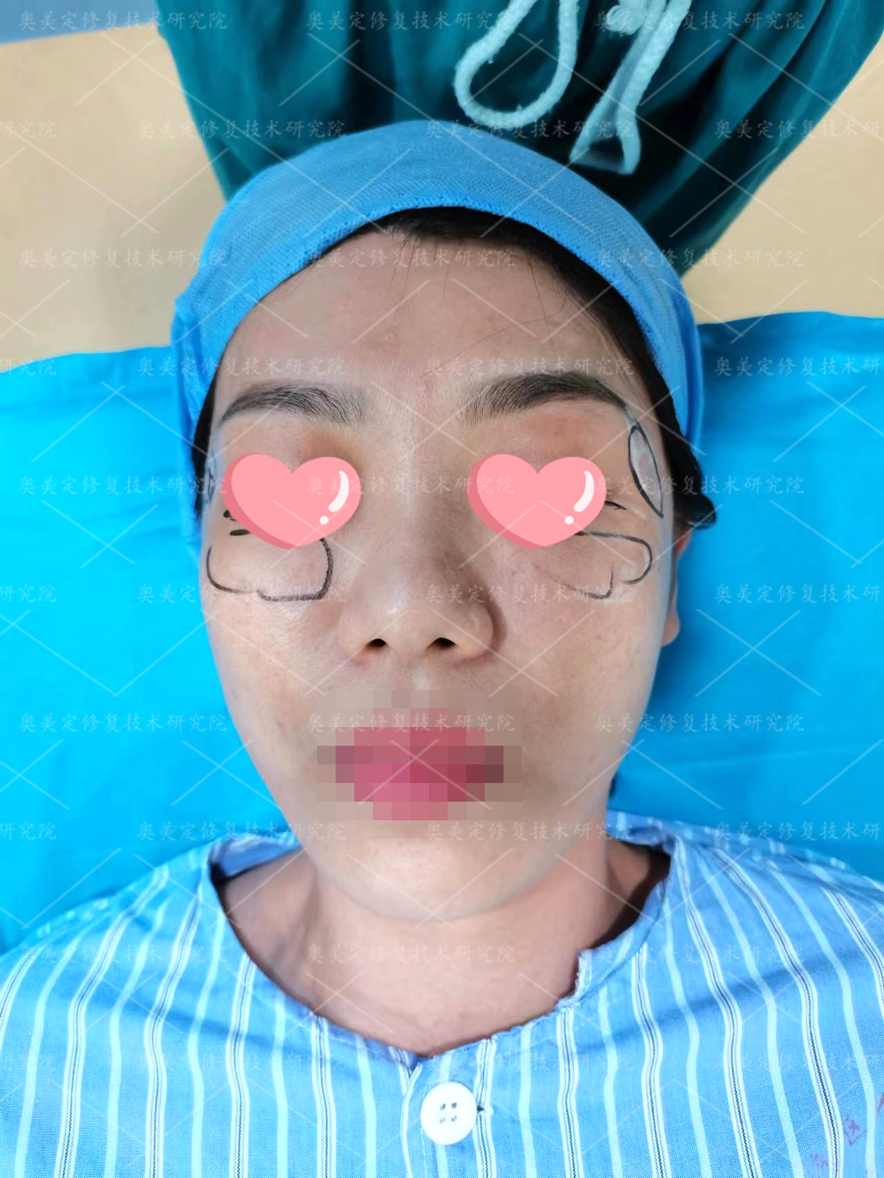 泪沟注射“玻尿酸”6年导致鼓包发硬，取出才知是奥美定