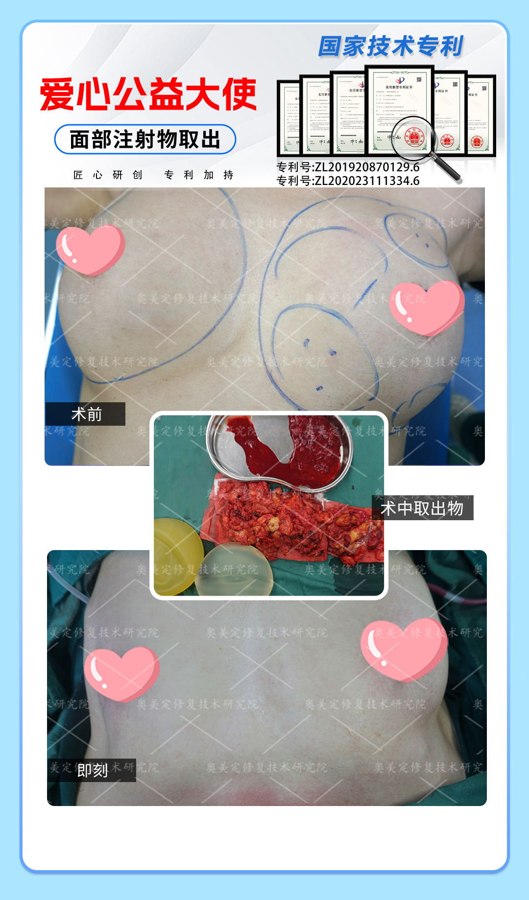 奥美定注射隆胸后要取出吗？