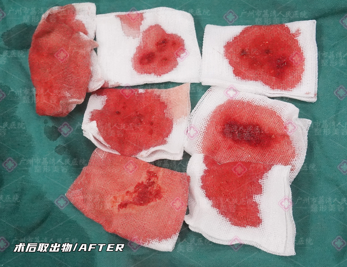 捷克水分子丰体针注射物是怎样取出的